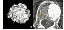 《图1 椎体及骨水泥三维模型创建1a.骨折椎体三维模型1 b.骨折线区域三维CAD模型1c.术后椎体三维模型1 d.骨水泥三维建模1e.单层骨水泥面积》